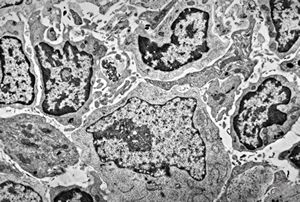 M,2y. | lymph node - lymphogranuloma - R-S cell M,2y. | lymph node - lymphogranuloma - R-S cell